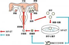 胚胎移植时为什么要憋尿？