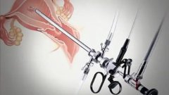 教你如何预约宫腔镜检查